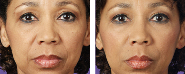 juvederm-voor-en-na-fotos